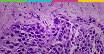J&J's real-world bladder cancer study started in HealthVerity Marketplace